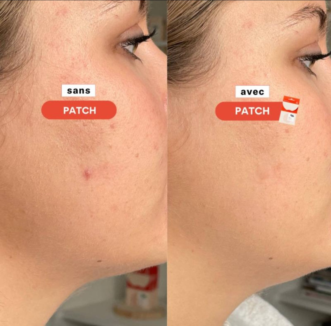 GlowPatch Overnight Acne Pimple Patch Clear Skin Rescue Kit
