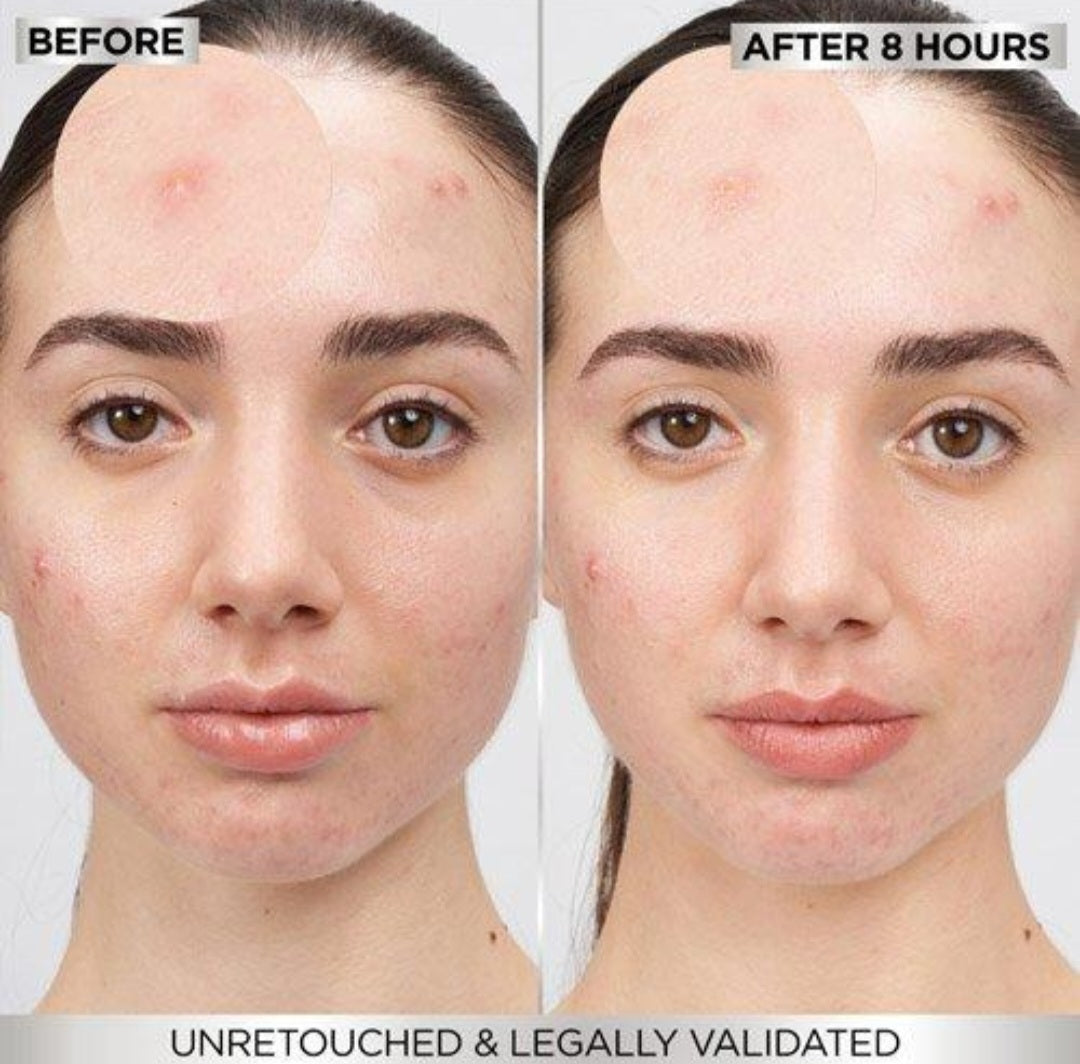 GlowPatch Overnight Acne Pimple Patch Clear Skin Rescue Kit